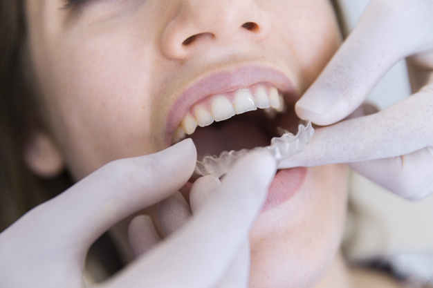 close-up-dentist-s-hand-fixing-transparent-aligner-female-patient-s-teeth_23-2147879311
